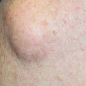 Lumps or Bump Scan - £100